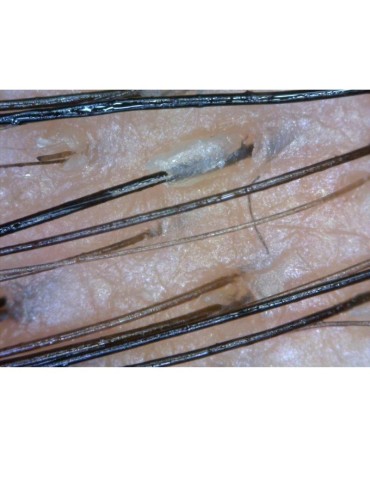 Dino-Lite Digital Trichoscope TRICHOSCOPE POLARIZER HR Digital Trichoscopy DinoLite MEDL7HM