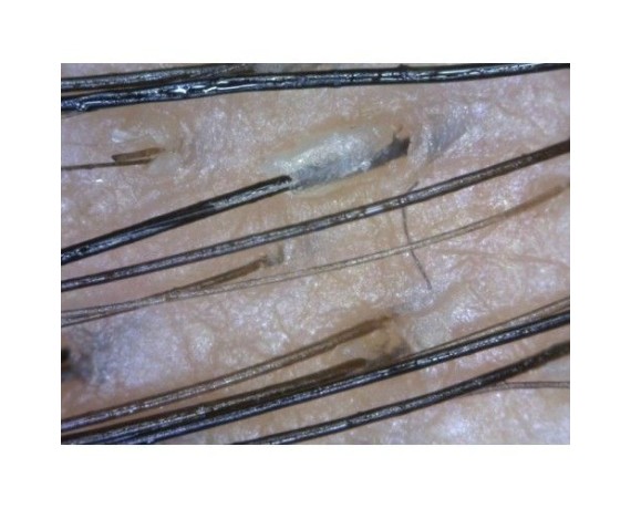 Trichoscope Dinolite BASIC Trichoscope numérique Trichoscopie numérique DinoLite MEDL3H