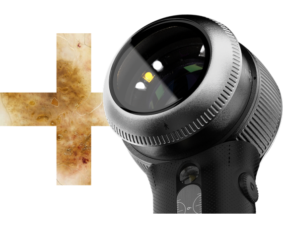 DermLite DL5 Plus dermatoscopio ibrido digitale portatileDermatoscopi Dermlite Dermlite DL5 Plus