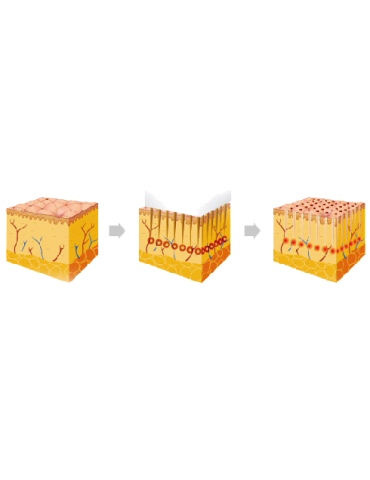 Infini Lutronic Fraktioneret Mikronål Radiofrekvens Bipolar Fraktioneret RF Lutronic