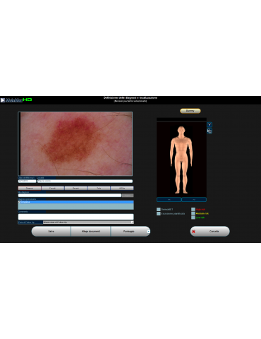 Molemax HDVideo Digitale Videodermatoscoop Dermatoscopen Derma Medische Systemen