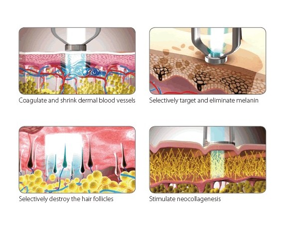 Lutronic Clarity Laser Nd:YAG Alessandrite Laser Nd:YAG e Alessandrite Lutronic CLARITY