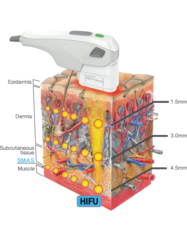 CHUNGWOO Contlex HIFU Fokusoitu Ultraääni Fokusoitu Ultraääni - HIFU CHUNGWOO CWM-940