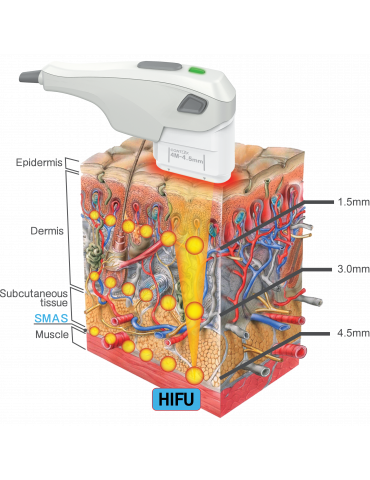 CHUNGWOO Contlex HIFU Ultrason focalisé ultrasons - HIFU CHUNGWOO CWM-940