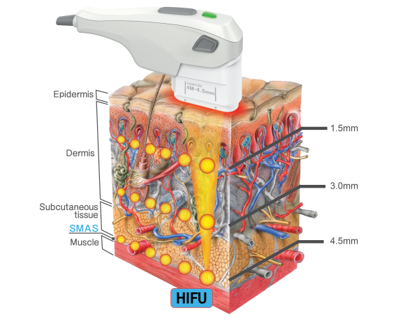 CHUNGWOO Contlex HIFU Ultrasuoni FocalizzatiUltrasuoni Focalizzati - HIFU CHUNGWOO CWM-940